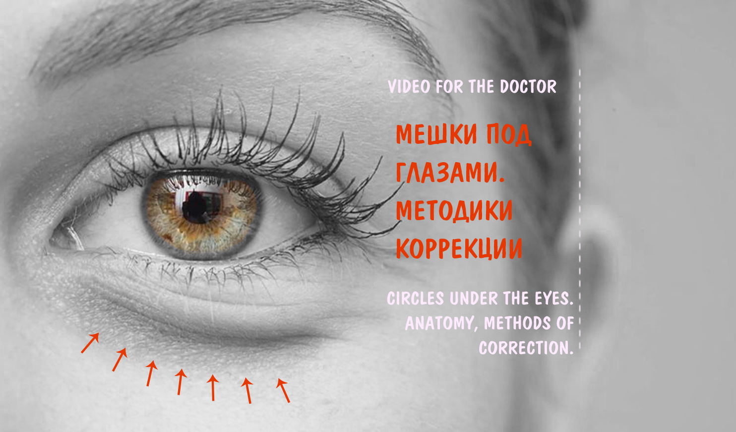 Мешки под глазами анатомия. Мешки под глазами схема. Периорбитальная зона презентация. Circles under the Eyes.